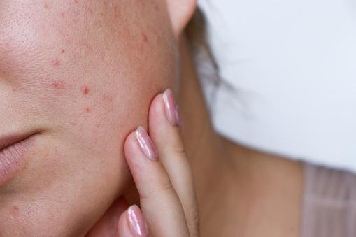 Dormir com o cabelo molhado pode facilitar o surgimento de acne. (Fonte: GettyImages/Reprodução)