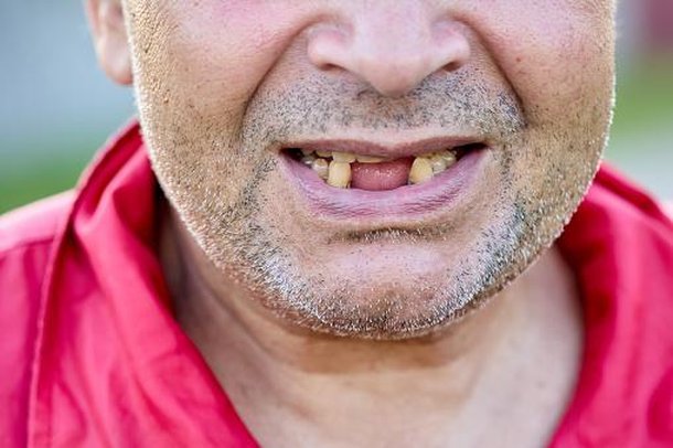 Banguela define uma pessoa sem dentes, e é bastante utilizada na África. (Fonte: GettyImages/Reprodução)
