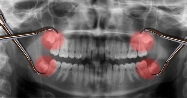 Muitos dentes do siso estão mal posicionados e precisam ser extraídos. (Fonte: Getty Images / Reprodução)