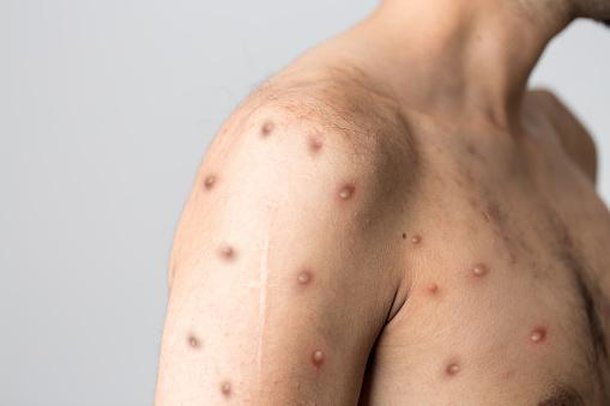 Lesões na pele são sintomas comuns da doença. (Fonte: Getty Images)