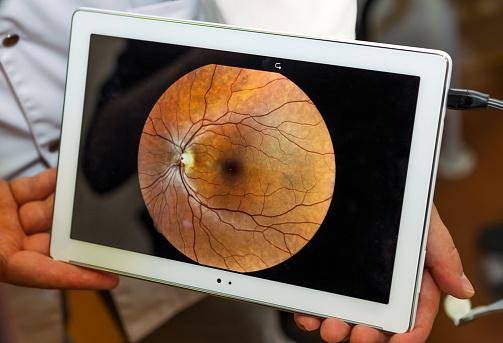 Lesões na retina podem indicar outras doenças, como a diabetes.